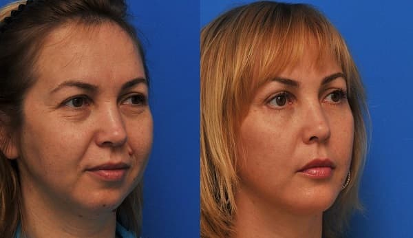 Подтяжка мышц лица_безоперационные методы