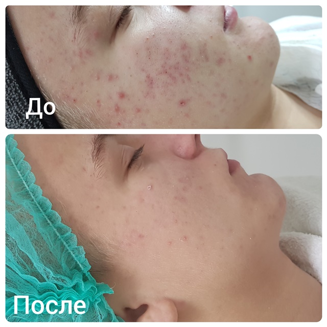 Атравматичная чистка проводится в несколько связанных между собой последовательных этапов Атравматичная чистка проводится в несколько связанных между собой последовательных этапов