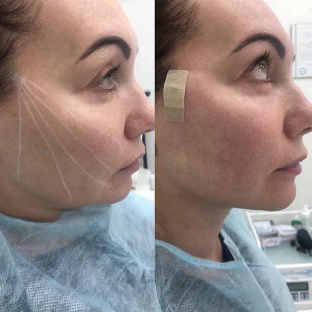 Как проходит армирование нитями Aptos Visage Как проходит армирование нитями Aptos Visage