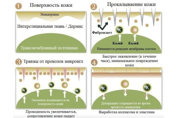 Фракционная мезотерапия кожи лица_этапы