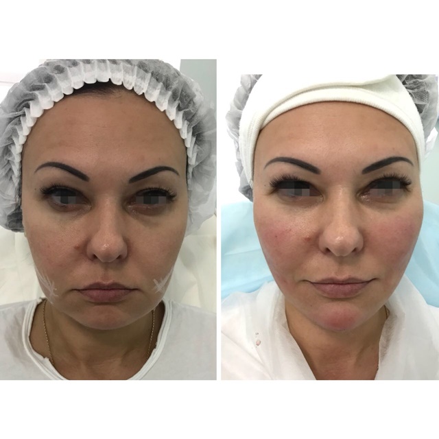 Кому показано применение нитей Aptos Visage Кому показано применение нитей Aptos Visage